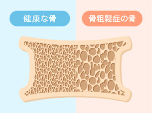 健康な骨と骨粗鬆症の骨の比較